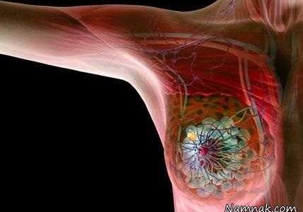 تشخیص و پیشگیری از سرطان پستان؟