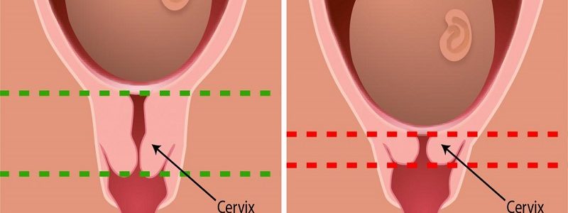 بررسی طول سرویکس در بارداری